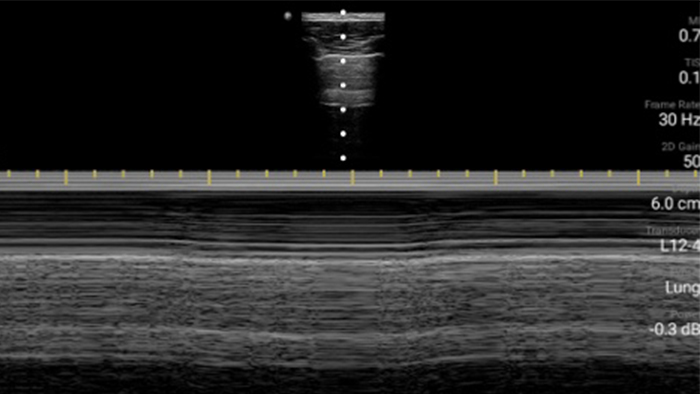 Tercer pulm&oacute;n en miniatura